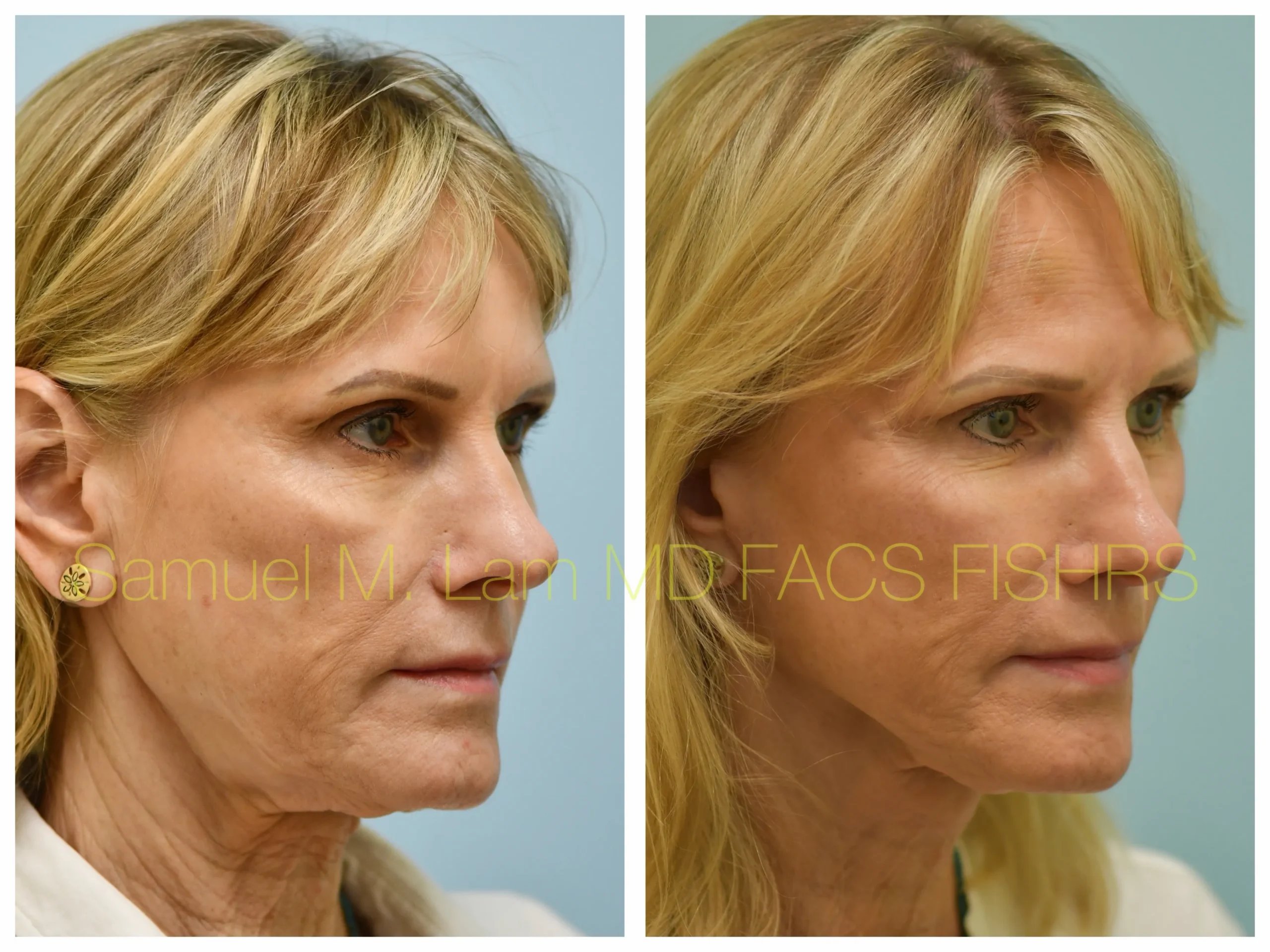 right oblique view deep plane facelift before and after photo by Dr. Sam Lam