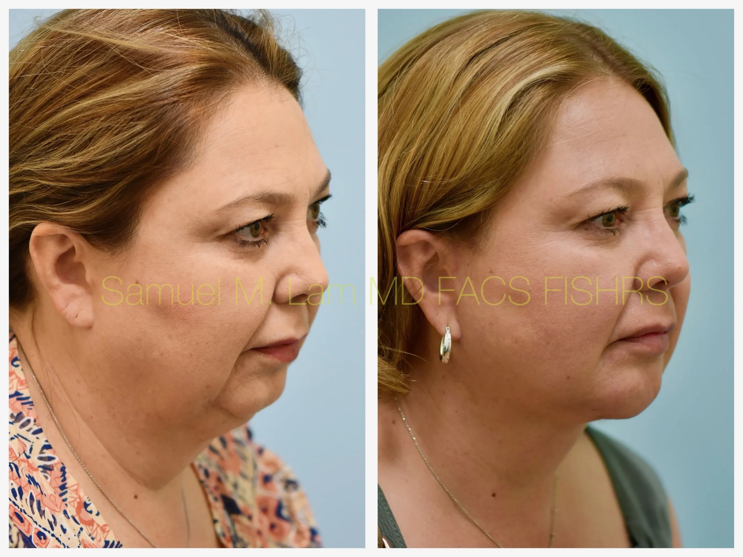 right oblique view face and neck lift and chin implant before and after photo by Dr. Sam Lam right oblique view face and neck lift and chin implant before and after photo by Dr. Sam Lam
