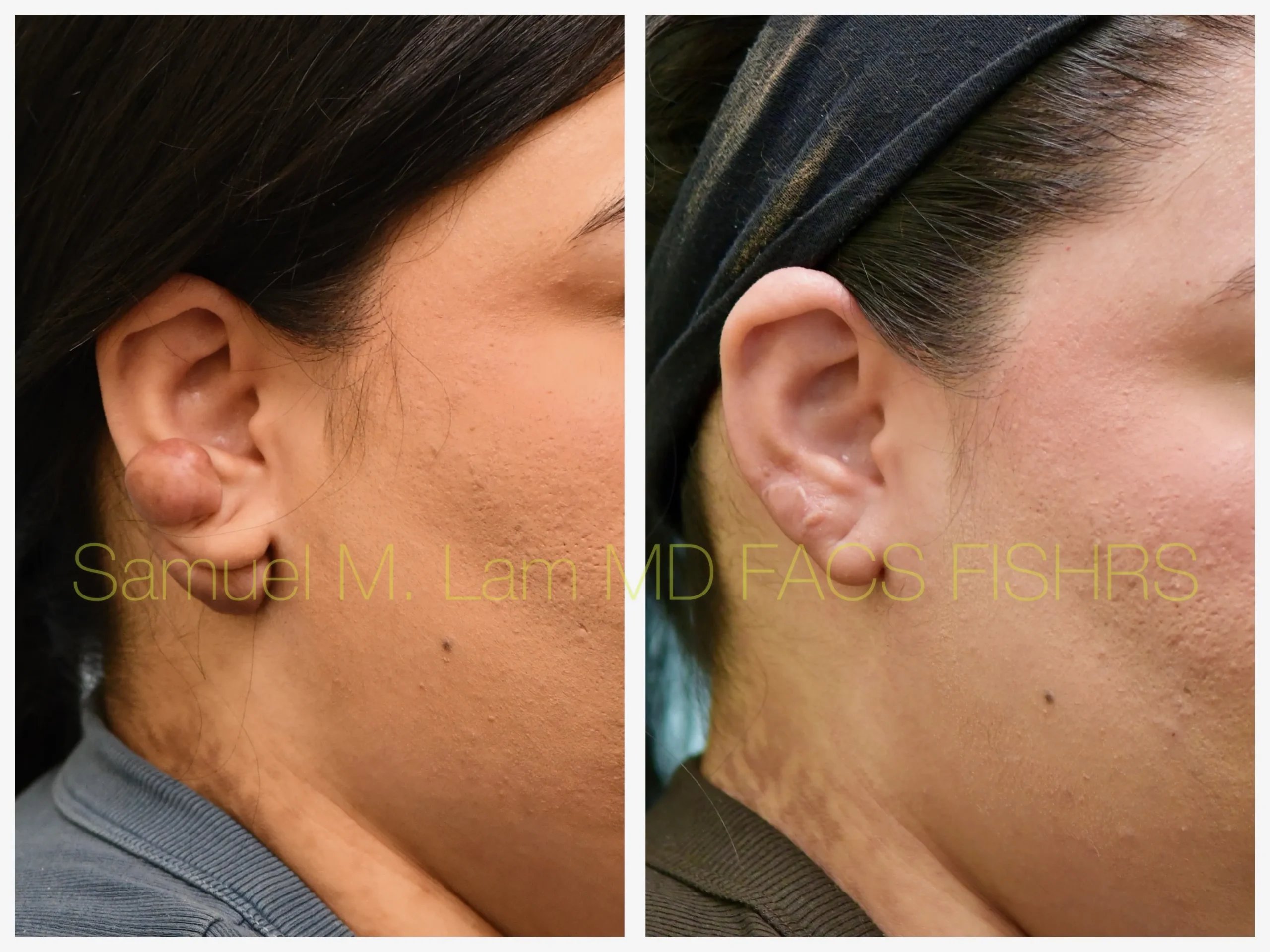 right oblique view keloids removal before and after photo by Dr. Sam Lam right oblique view keloids removal before and after photo by Dr. Sam Lam