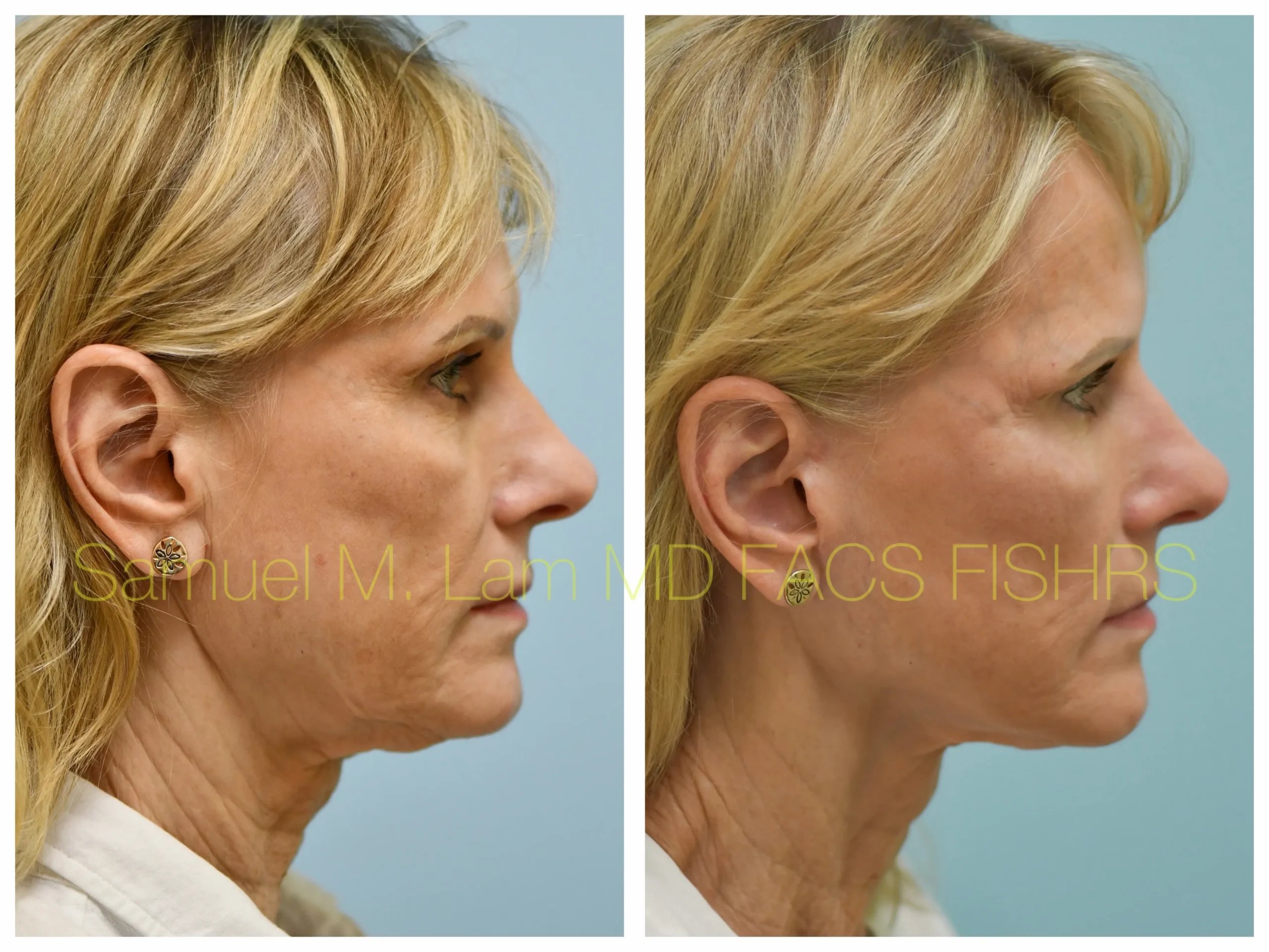 right side view deep plane facelift before and after photo by Dr. Sam Lam