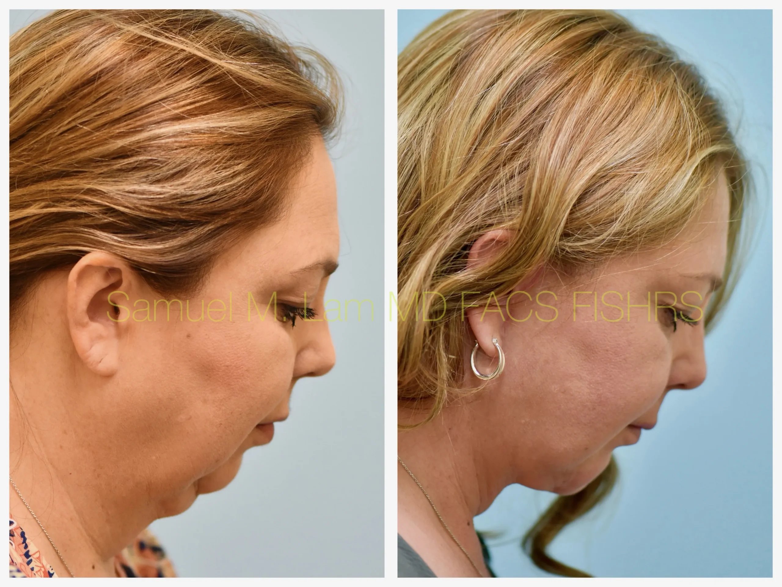 right side view face and neck lift and chin implant before and after photo by Dr. Sam Lam right side view face and neck lift and chin implant before and after photo by Dr. Sam Lam