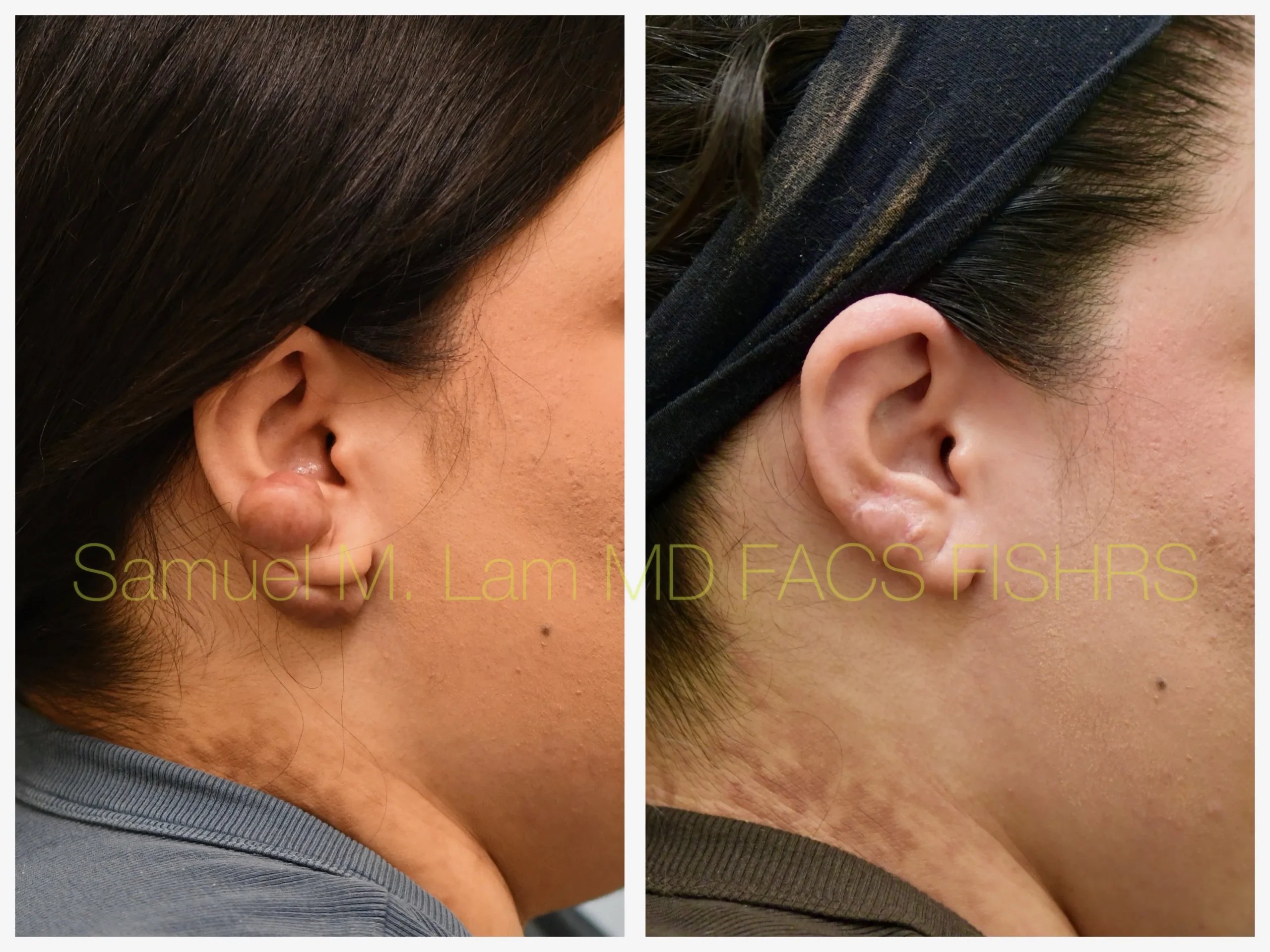 right side view keloids removal before and after photo by Dr. Sam Lam right side view keloids removal before and after photo by Dr. Sam Lam