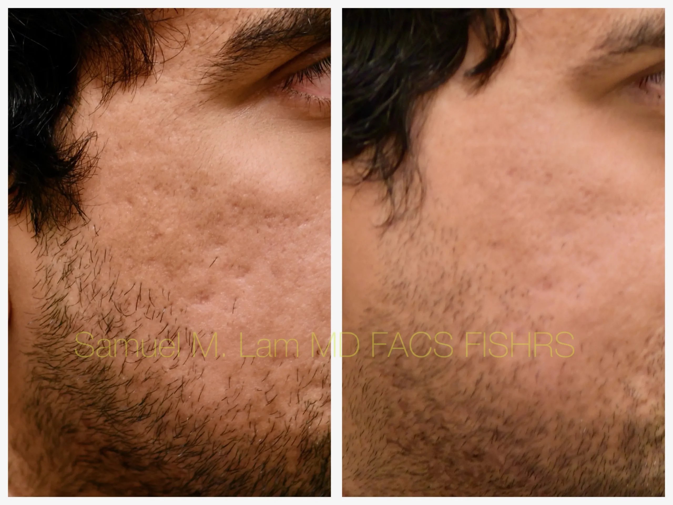 close up view Acne scar correction MesoBotox before and after photo by Dr. Sam Lam close up view Acne scar correction MesoBotox before and after photo by Dr. Sam Lam