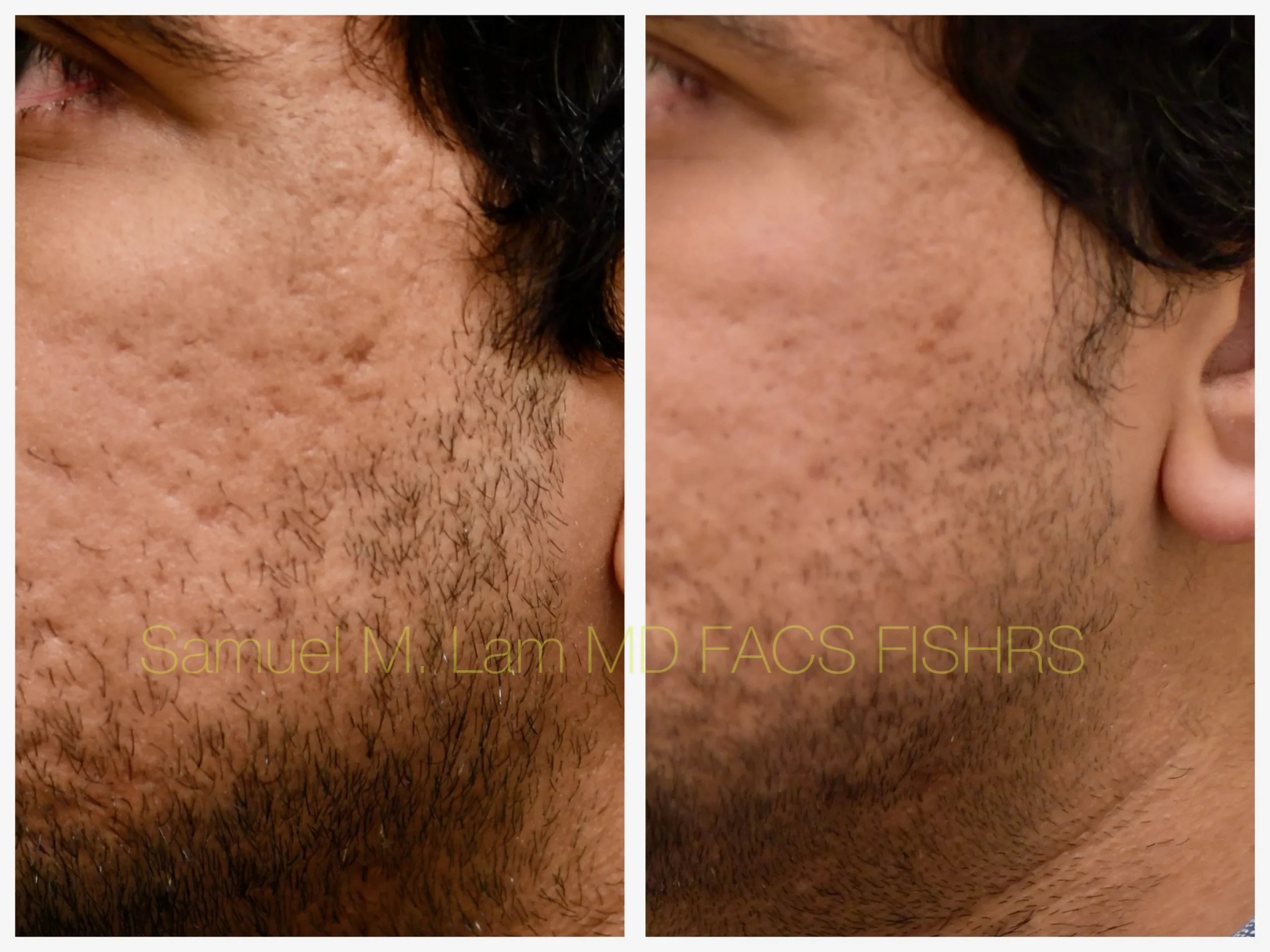 closeup view Acne scar correction MesoBotox before and after photo by Dr. Sam Lam closeup view Acne scar correction MesoBotox before and after photo by Dr. Sam Lam