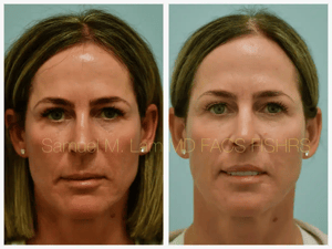 Lip Lift Before and After Photo by Dr. Lam in Plano TX Lip Lift Before and After Photo by Dr. Lam in Plano TX