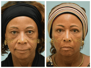 Blepharoplasty fat grafting fillers MesoBotox lip lift Before and After Photo by Dr. Lam in Plano TX Blepharoplasty fat grafting fillers MesoBotox lip lift Before and After Photo by Dr. Lam in Plano TX