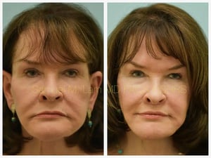 Lip lift Before and After Photo by Dr. Lam in Plano TX Lip lift Before and After Photo by Dr. Lam in Plano TX