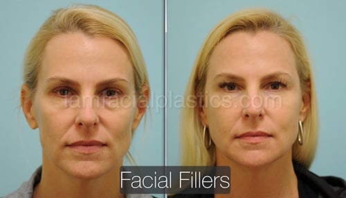 before and after fillers before and after fillers