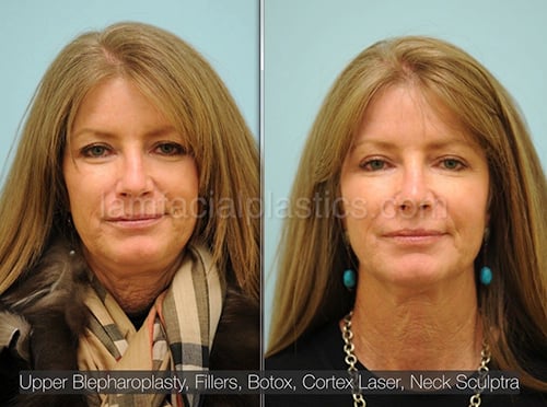 before and after fillers before and after fillers