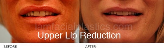 lip reduction bxa lip reduction bxa