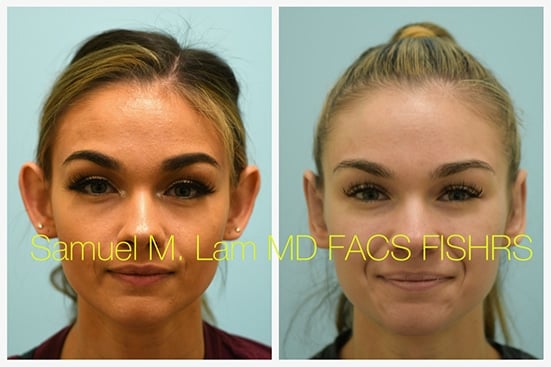 otoplasty of