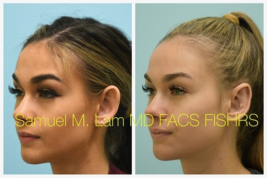 otoplasty of