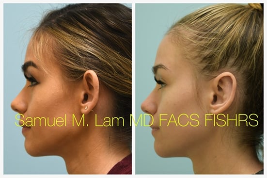 otoplasty of