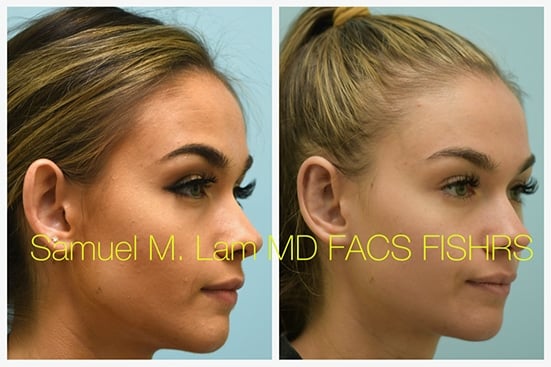 otoplasty of