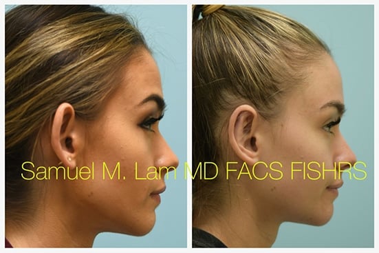 otoplasty of
