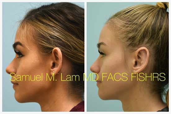 otoplasty of