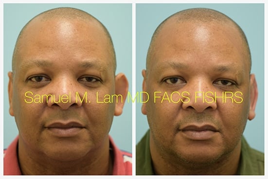 otoplasty of