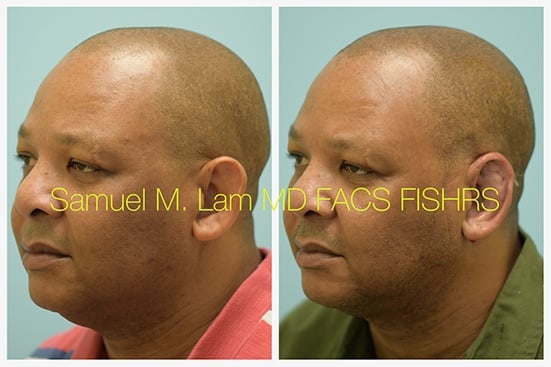 otoplasty of