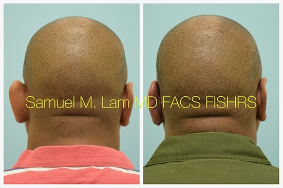 otoplasty of