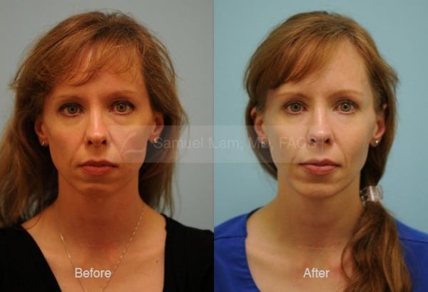 13518-01of02 Cheek Augmentation Result Dallas