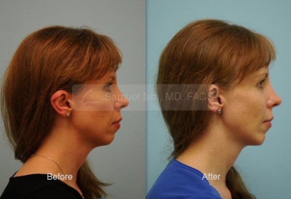 13518-02of02 Cheek Augmentation Result Dallas