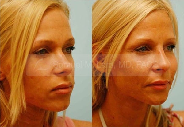 13523-01of02 Cheek Augmentation Result Dallas