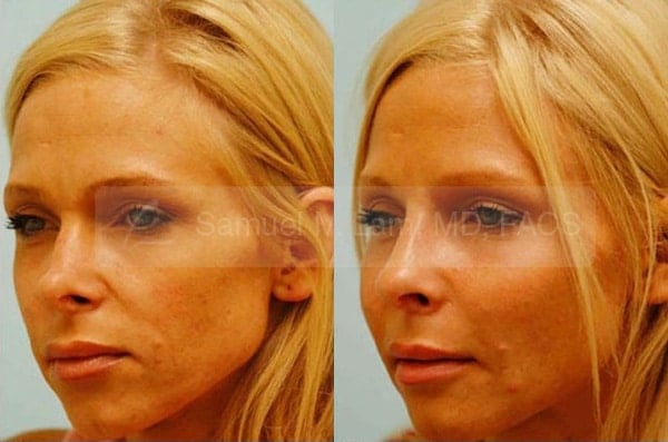 13523-02of02 Cheek Augmentation Result Dallas