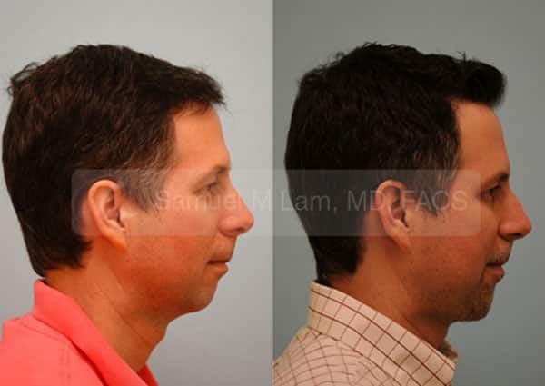 13536-01of01 Cheek Augmentation Result Dallas