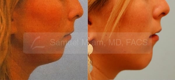 13542-01of01 Cheek Augmentation Result Dallas