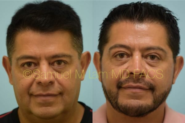 Cheek Augmentation Result Dallas