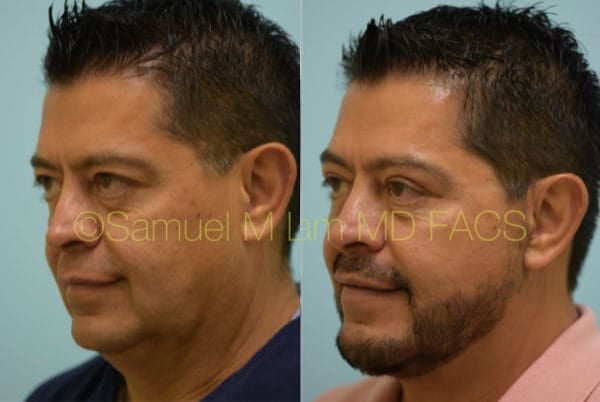 Cheek Augmentation Before and after