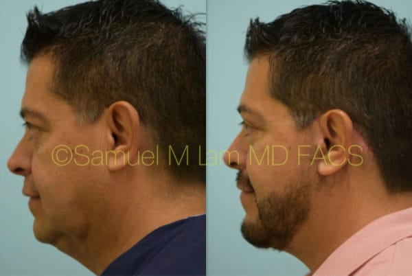 Cheek Augmentation Before and after