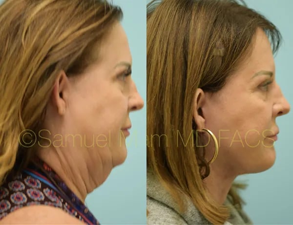 facelift before and after photo by sam lam patient facelift before and after photo by sam lam patient