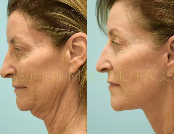 facelift before and after photo by sam lam patient facelift before and after photo by sam lam patient