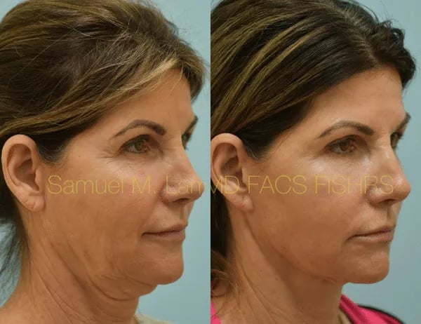 facelift before and after photo by sam lam patient facelift before and after photo by sam lam patient
