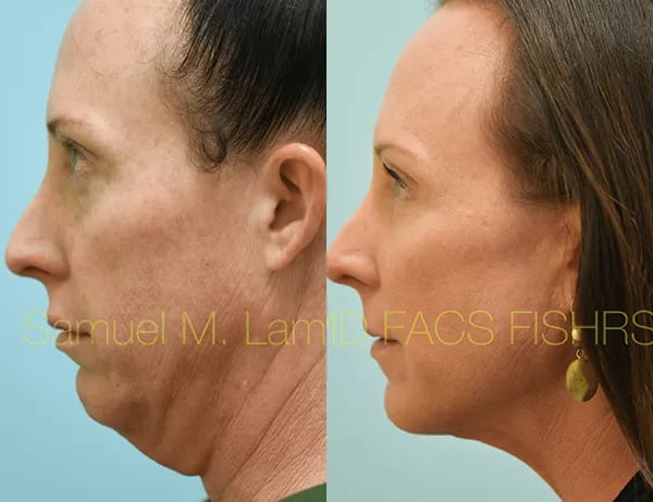 facelift before and after photo by sam lam patient facelift before and after photo by sam lam patient