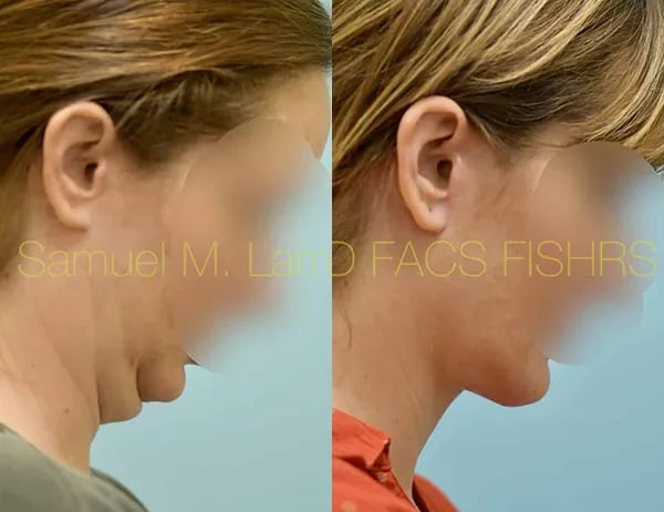 facelift before and after photo by sam lam patient facelift before and after photo by sam lam patient