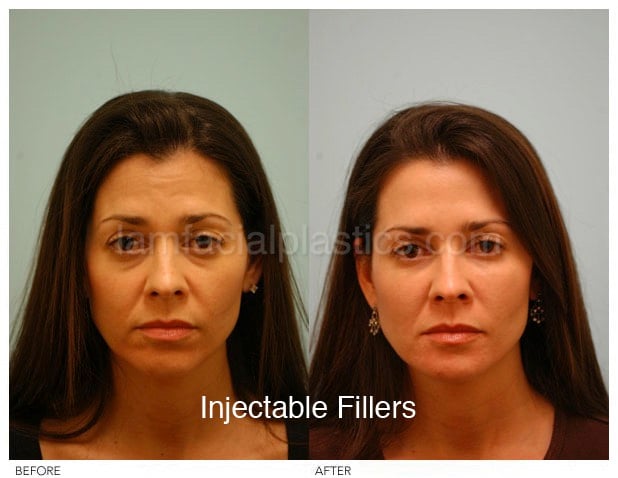 before and after fillers before and after fillers