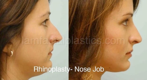 Rhinoplasty Before and After Photo by Dr. Lam in Plano TX