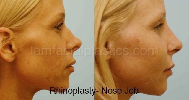Rhinoplasty Before and After Photo by Dr. Lam in Plano TX
