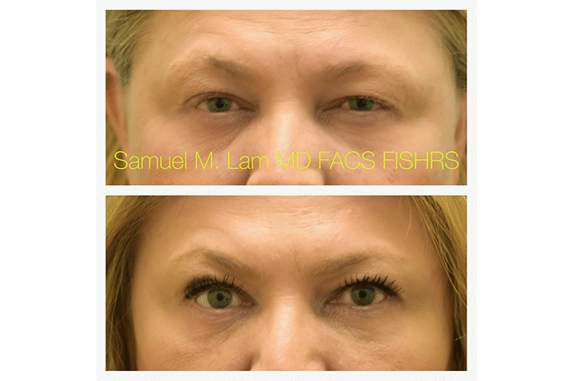 Upper Blepharoplasty Before and After Photo - Dr. Sam Lam - Dallas, TX Upper Blepharoplasty Before and After Photo - Dr. Sam Lam - Dallas, TX