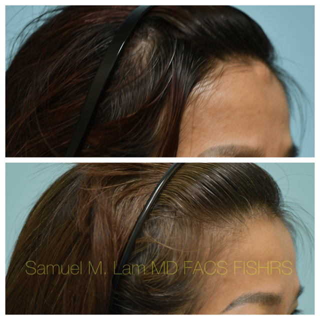 Osteoma Before and After Photo by Dr. Lam in Plano TX Osteoma Before and After Photo by Dr. Lam in Plano TX