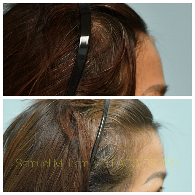Osteoma Before and After Photo by Dr. Lam in Plano TX Osteoma Before and After Photo by Dr. Lam in Plano TX