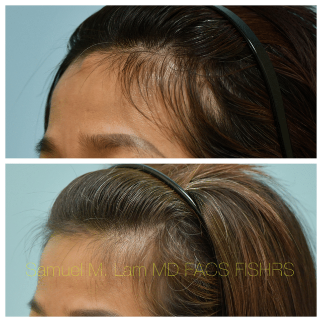 Osteoma Before and After Photo by Dr. Lam in Plano TX Osteoma Before and After Photo by Dr. Lam in Plano TX