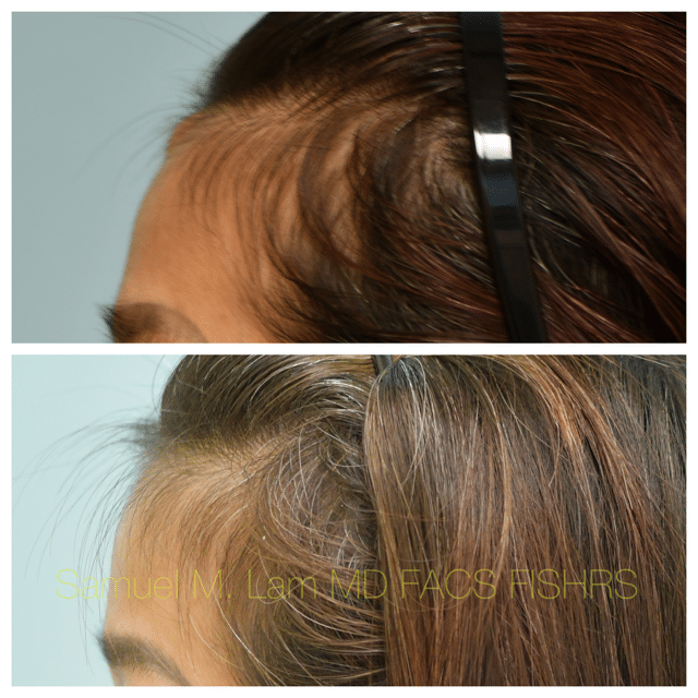 Osteoma Before and After Photo by Dr. Lam in Plano TX Osteoma Before and After Photo by Dr. Lam in Plano TX
