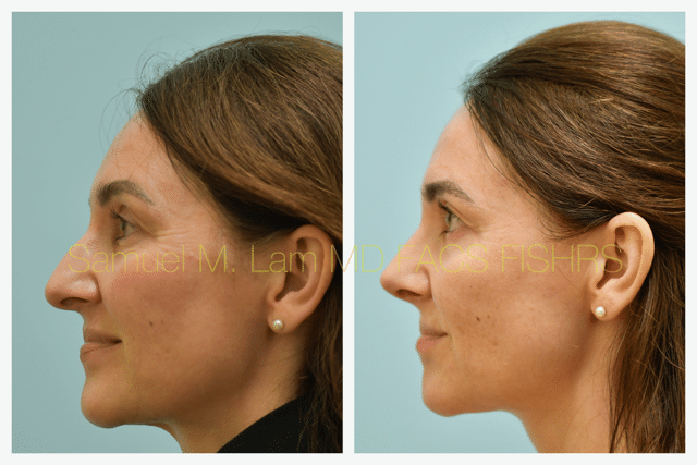 Rhinoplasty Before and After Photo by Dr. Lam in Plano TX Rhinoplasty Before and After Photo by Dr. Lam in Plano TX