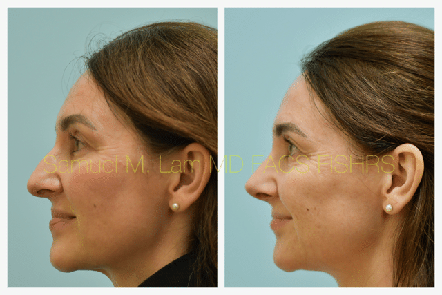Rhinoplasty Before and After Photo by Dr. Lam in Plano TX Rhinoplasty Before and After Photo by Dr. Lam in Plano TX