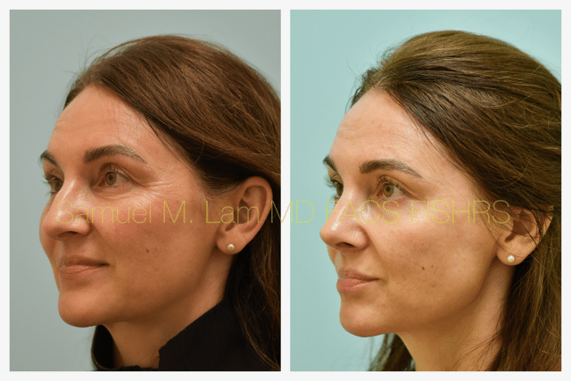 Rhinoplasty Before and After Photo by Dr. Lam in Plano TX Rhinoplasty Before and After Photo by Dr. Lam in Plano TX
