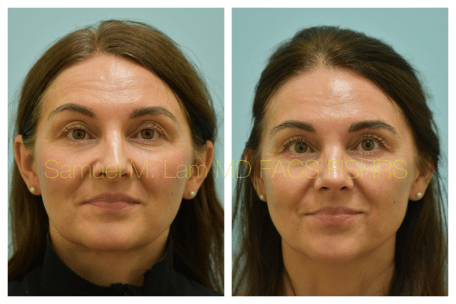 Rhinoplasty Before and After Photo by Dr. Lam in Plano TX Rhinoplasty Before and After Photo by Dr. Lam in Plano TX