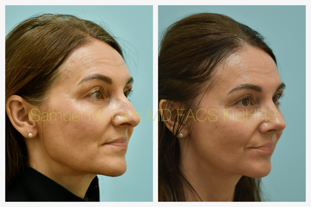 Rhinoplasty Before and After Photo by Dr. Lam in Plano TX Rhinoplasty Before and After Photo by Dr. Lam in Plano TX